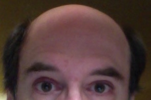 baldness-crop.jpg