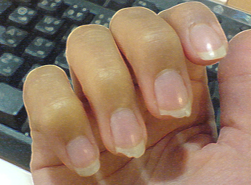 Broken_Finger_nails.jpg