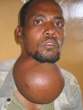 Goiter-2.jpg
