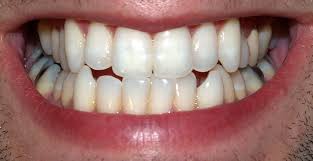 teeth.jpeg