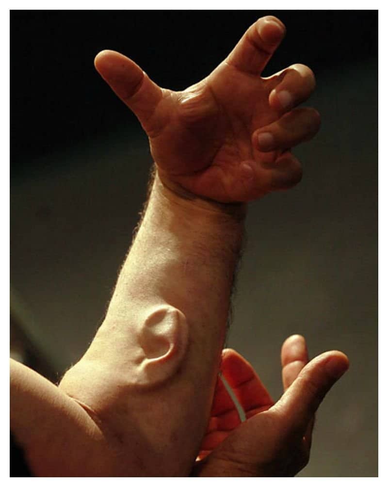 this-man-is-growing-a-third-ear-from-his-arm-you-wont-believe-why-1.jpg