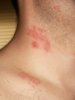 Herpes_zoster_neck.jpg