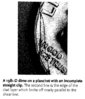 IncompStrClip (2).jpg